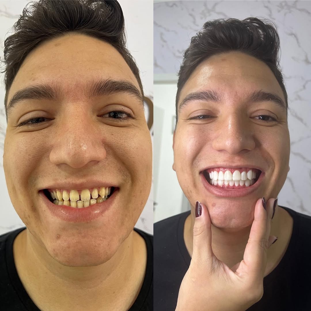 Lentes em Resina Composta (antes e depois)